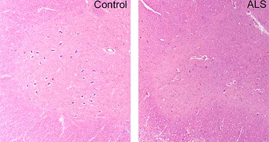 Amyotrophic lateral sclerosis (ALS), cervical spinal cord, hematoxylin and eosin (H&E) stained section showing marked loss of lower motor neurons compared to control.